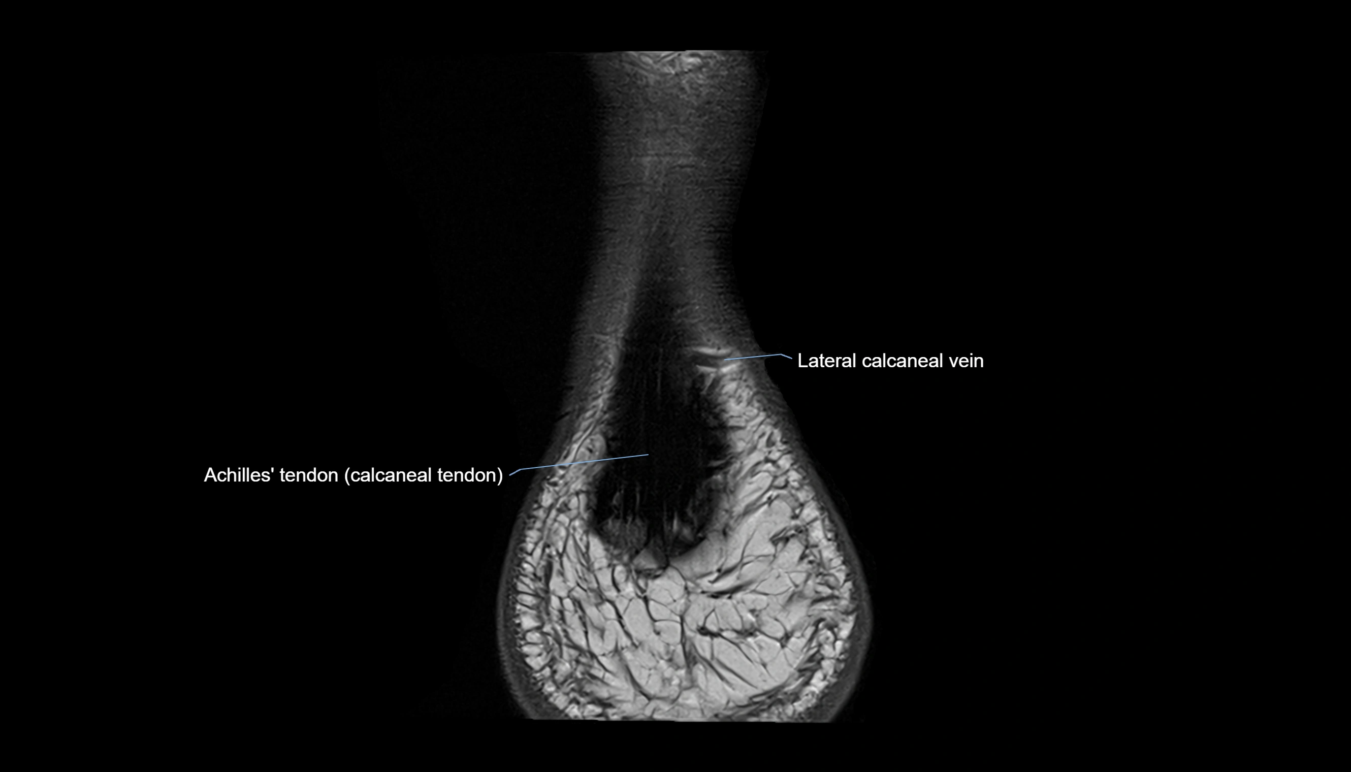 Ankle coronal anatomy 3T MRI images -img-11001-00032.webp